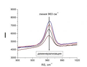 Снижение интенсивности рамановской линии гидроксиапатитов (963 см-1) при развитии кариеса за счет падения степени деминерализации зуба